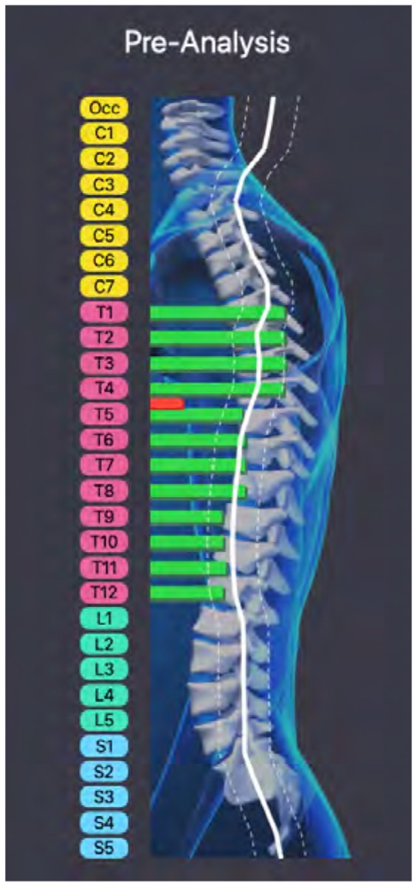 Example pre-analysis chart from the hand test: long, even green bars at T1 to T4 for the heel of the hand, shorter bars at T5 to T8 for the palm, and the shortest bars at T9 to T12 for the fingertip.